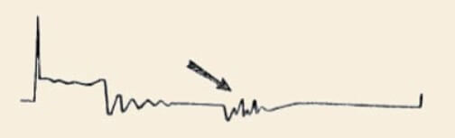 وجود مشکل در ناحیه داول