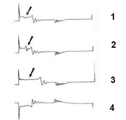 بررسی طول جرقه